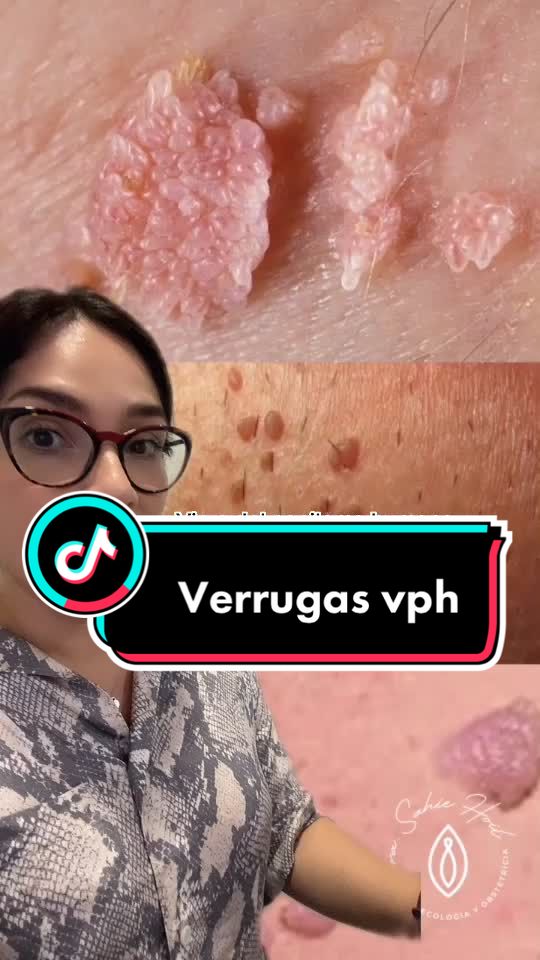 VPH: tipos de virus y tipos de verrugas que causa