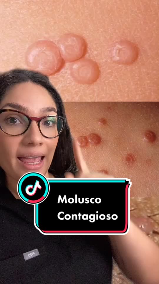 Molusco Contagioso: qué es y cómo diferenciarlo del VPH